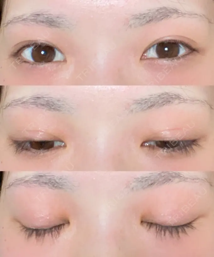 二重切開 有楽町高野美容クリニック AFTER メイン用