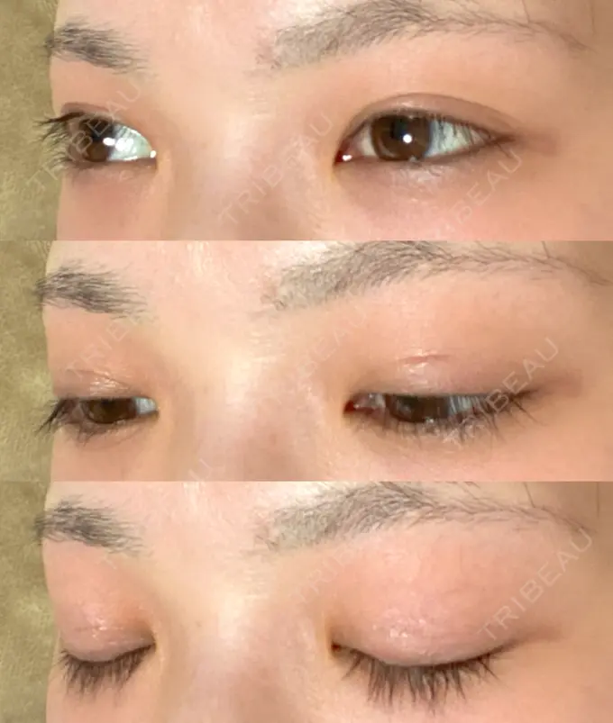 二重切開 有楽町高野美容クリニック DAY 259 メイン用