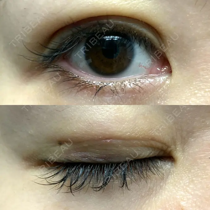 二重埋没 札幌ル・トロワ ビューティクリニックVogue DAY 4 メイン用