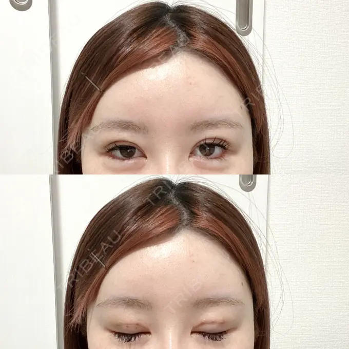 二重埋没 / その他（目元） CLASSY 仙台美容外科・美容皮膚科 DAY 2 メイン用