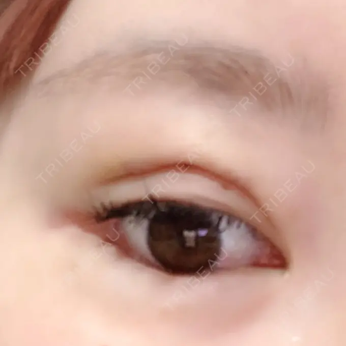 二重埋没 / その他（目元） CLASSY 仙台美容外科・美容皮膚科 DAY 2 メイン用