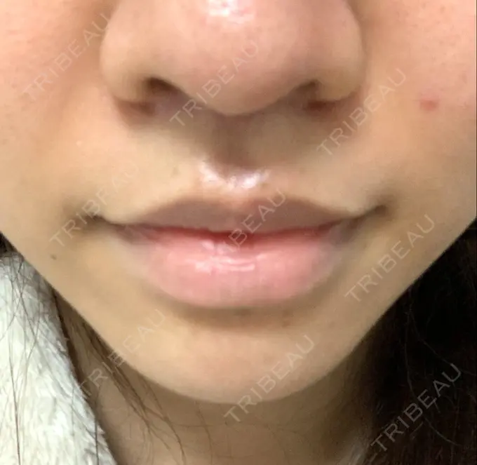 人中短縮 新宿ラクル美容外科クリニック 新宿院 DAY 62 メイン用