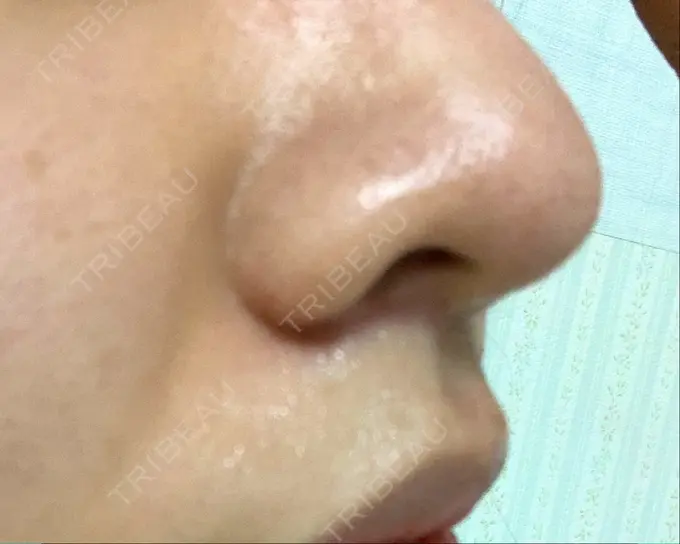 人中短縮 新宿ラクル美容外科クリニック 新宿院 DAY 62 メイン用