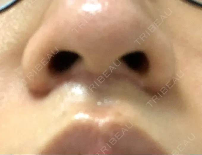 人中短縮 新宿ラクル美容外科クリニック 新宿院 DAY 62 メイン用