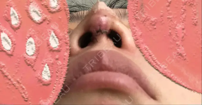 鼻尖形成（切開） / 軟骨移植 / ワシ鼻修正・ハンプ切除 麹町皮ふ科・形成外科クリニック DAY 3 メイン用