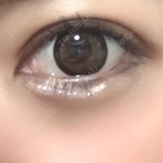 ヒアルロン酸注入（涙袋） プライベートスキンクリニック 梅田本院 DAY 7 メイン用