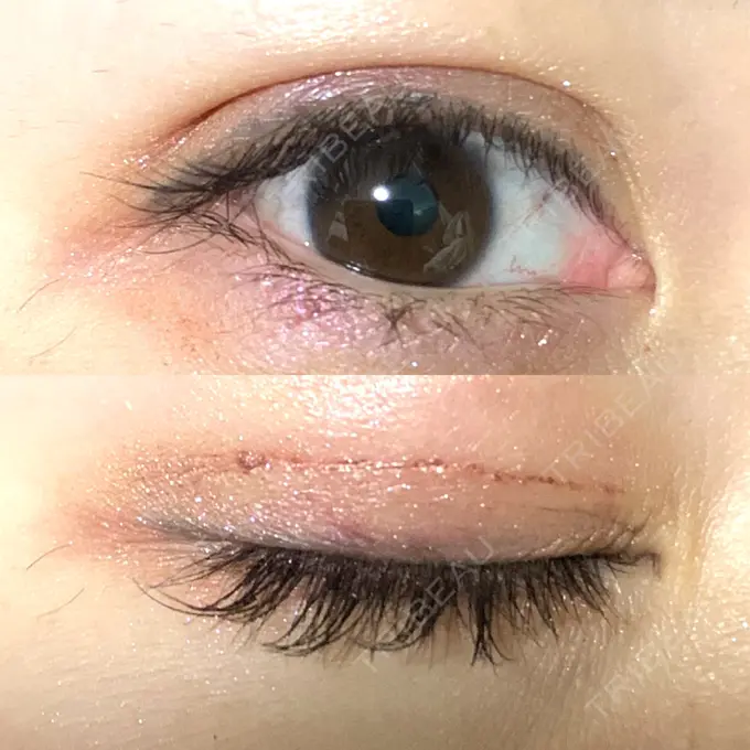 二重埋没 札幌ル・トロワ ビューティクリニックVogue DAY 5 メイン用