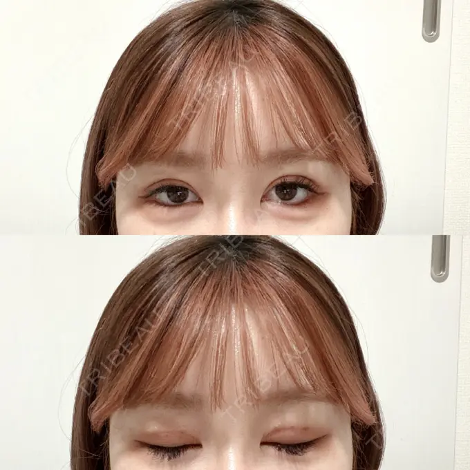 二重埋没 / その他（目元） CLASSY 仙台美容外科・美容皮膚科 DAY 3 メイン用