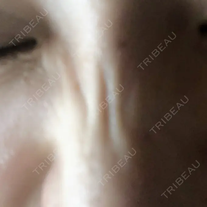 ボトックス（あご） 湘南美容クリニック 銀座院 DAY 6 メイン用