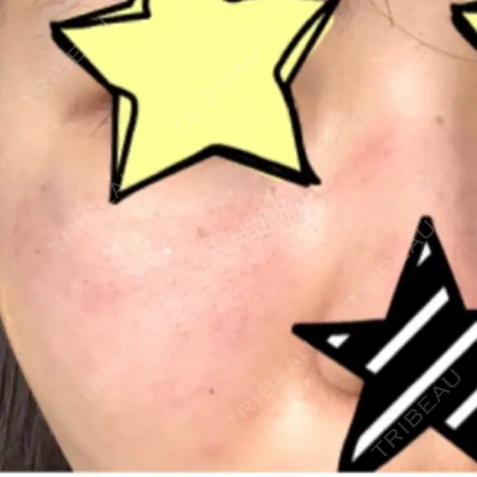 美肌レーザー / ほくろ・いぼ除去レーザー（肌） ニューセンス皮膚科クリニック DAY 1 メイン用