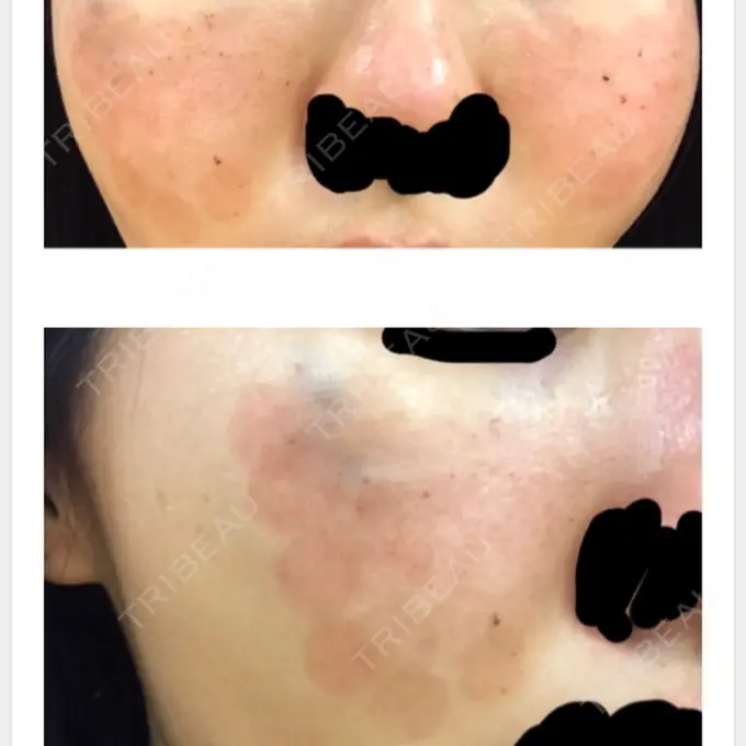 美肌レーザー / ほくろ・いぼ除去レーザー（肌） ニューセンス皮膚科クリニック DAY 2 メイン用