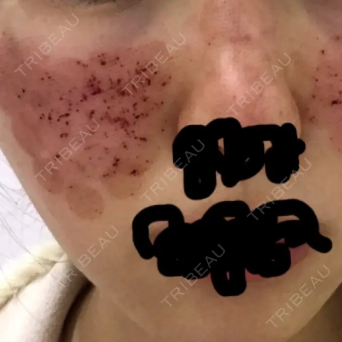 美肌レーザー / ほくろ・いぼ除去レーザー（肌） ニューセンス皮膚科クリニック DAY 3 メイン用