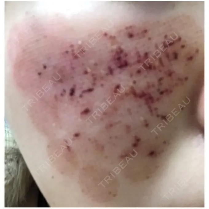 美肌レーザー / ほくろ・いぼ除去レーザー（肌） ニューセンス皮膚科クリニック DAY 4 メイン用