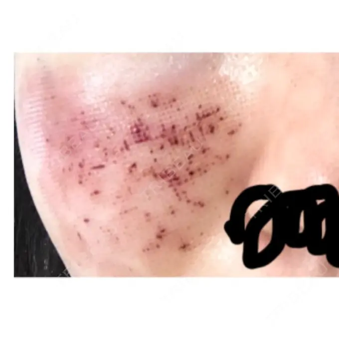 美肌レーザー / ほくろ・いぼ除去レーザー（肌） ニューセンス皮膚科クリニック DAY 5 メイン用