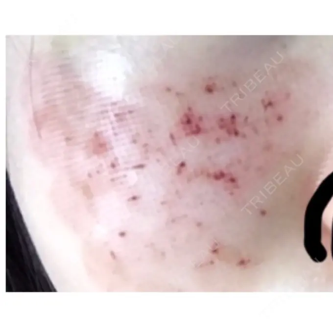 美肌レーザー / ほくろ・いぼ除去レーザー（肌） ニューセンス皮膚科クリニック DAY 6 メイン用