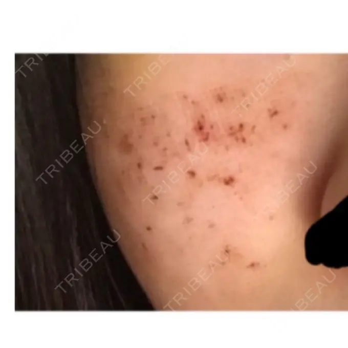 美肌レーザー / ほくろ・いぼ除去レーザー（肌） ニューセンス皮膚科クリニック DAY 7 メイン用