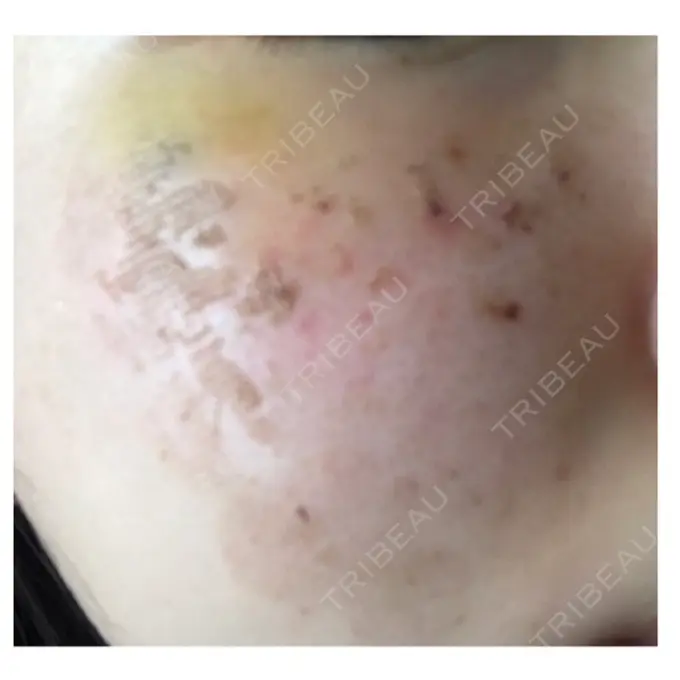 美肌レーザー / ほくろ・いぼ除去レーザー（肌） ニューセンス皮膚科クリニック DAY 8 メイン用