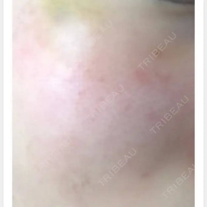 美肌レーザー / ほくろ・いぼ除去レーザー（肌） ニューセンス皮膚科クリニック AFTER メイン用