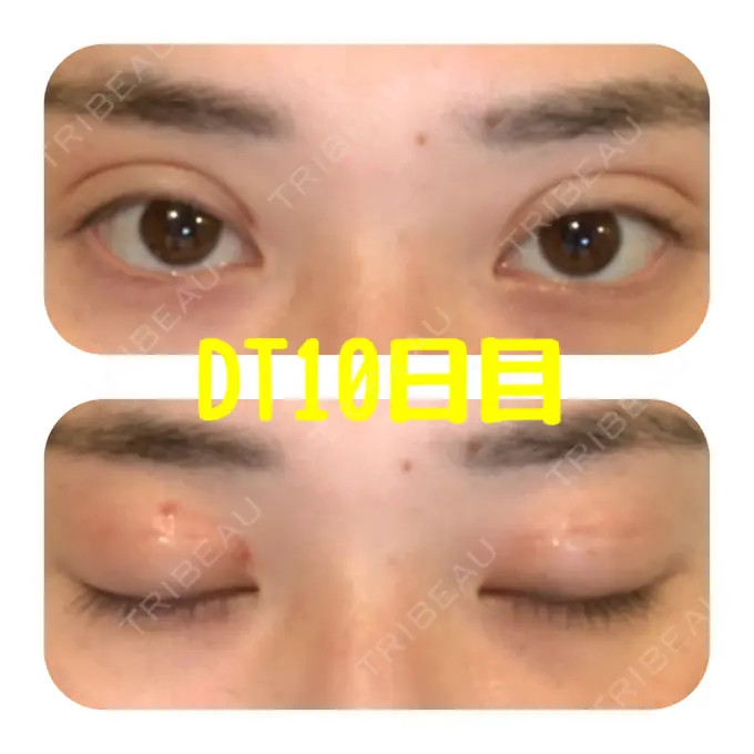 二重埋没 ハナビューティークリニック DAY 10 メイン用