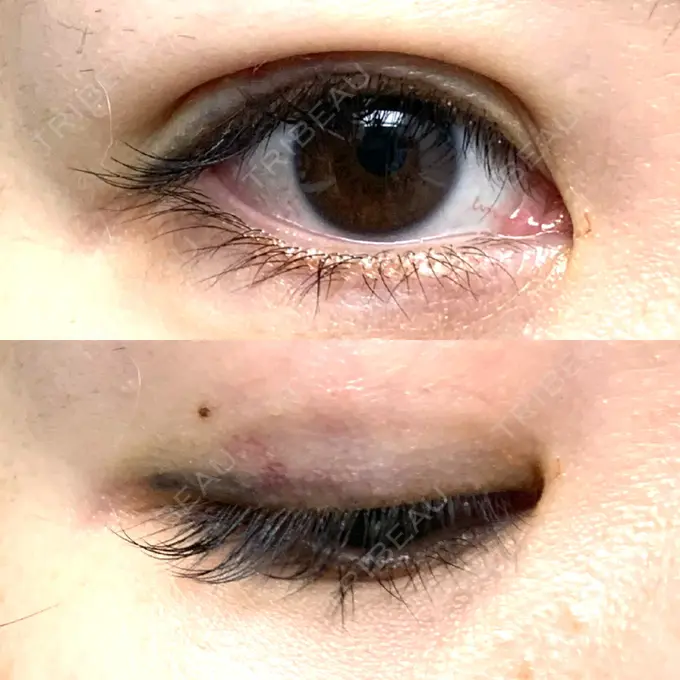 二重埋没 札幌ル・トロワ ビューティクリニックVogue DAY 6 メイン用