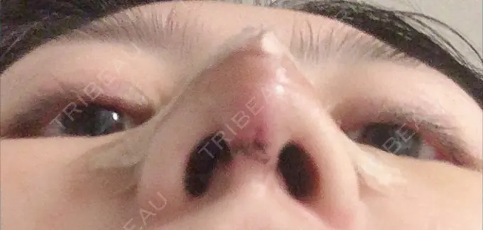 鼻尖形成（切開） / 軟骨移植 / ワシ鼻修正・ハンプ切除 麹町皮ふ科・形成外科クリニック DAY 5 メイン用