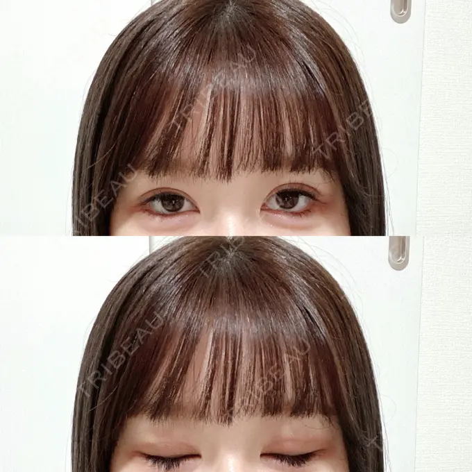 二重埋没 / その他（目元） CLASSY 仙台美容外科・美容皮膚科 DAY 5 メイン用