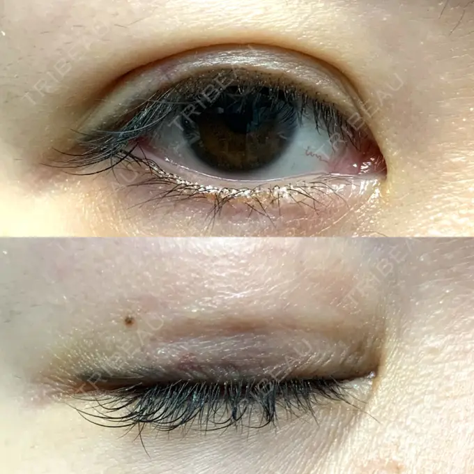 二重埋没 札幌ル・トロワ ビューティクリニックVogue DAY 7 メイン用