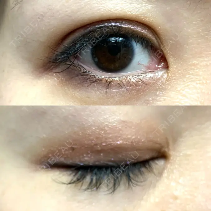 二重埋没 札幌ル・トロワ ビューティクリニックVogue DAY 8 メイン用