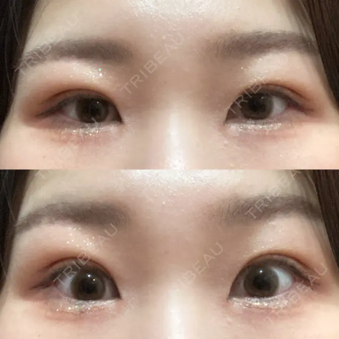 二重埋没 / 上まぶたの脂肪取り 品川スキンクリニック広島院 DAY 18 メイン用