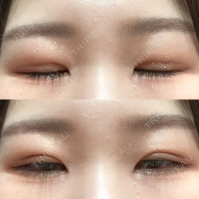 二重埋没 / 上まぶたの脂肪取り 品川スキンクリニック広島院 AFTER メイン用