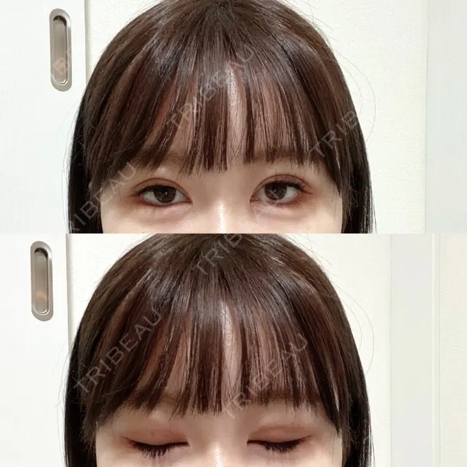 二重埋没 / その他（目元） CLASSY 仙台美容外科・美容皮膚科 DAY 6 メイン用