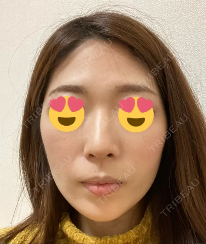 脂肪吸引（顔） ジョウクリニック 大阪院 DAY 70 メイン用