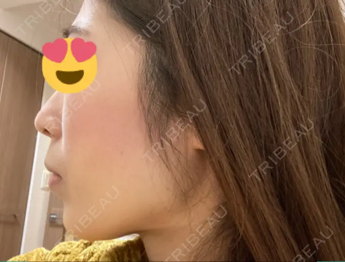 脂肪吸引（顔） ジョウクリニック 大阪院 DAY 70 メイン用