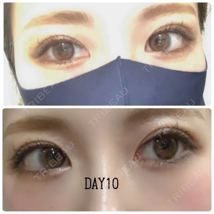 二重埋没 X CLINIC 恵比寿院 DAY 10 メイン用