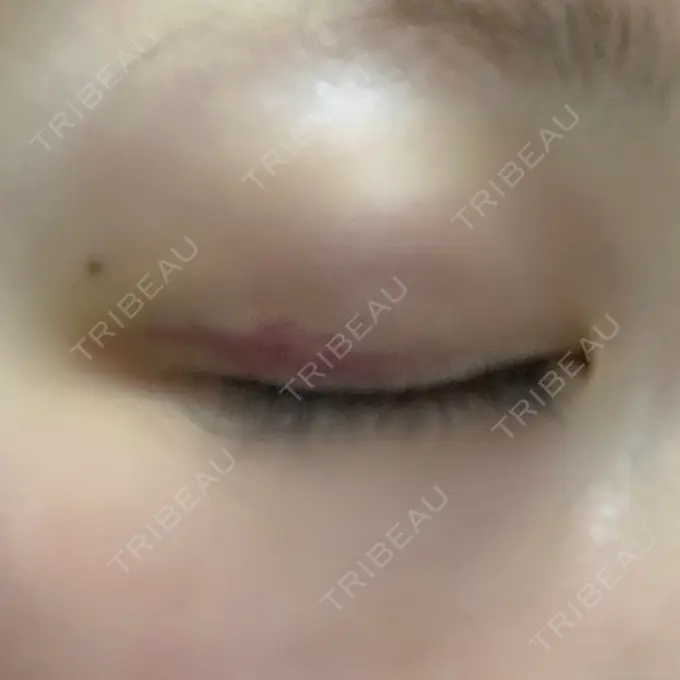 二重埋没 X CLINIC 恵比寿院 DAY 10 メイン用