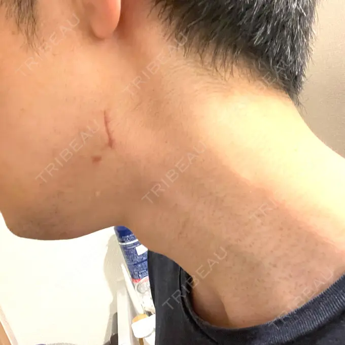 骨切り（あご） / 骨削り（エラ） 心斎橋コムロ美容外科クリニック DAY 60 メイン用