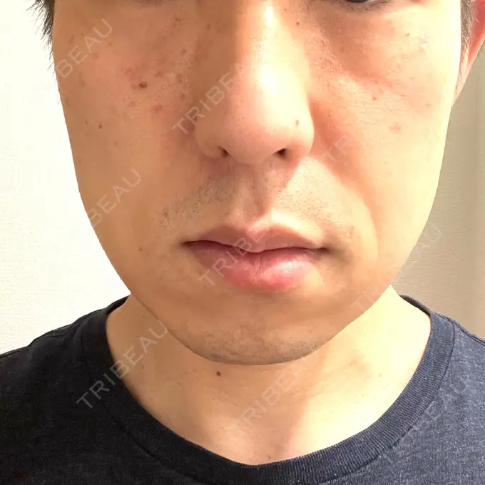 骨切り（あご） / 骨削り（エラ） 心斎橋コムロ美容外科クリニック DAY 60 メイン用