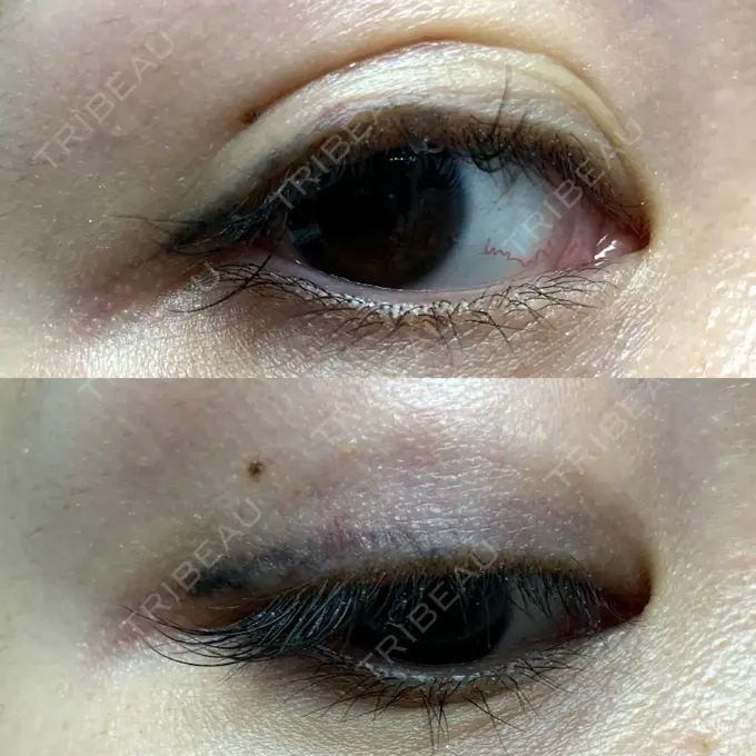 二重埋没 札幌ル・トロワ ビューティクリニックVogue DAY 9 メイン用