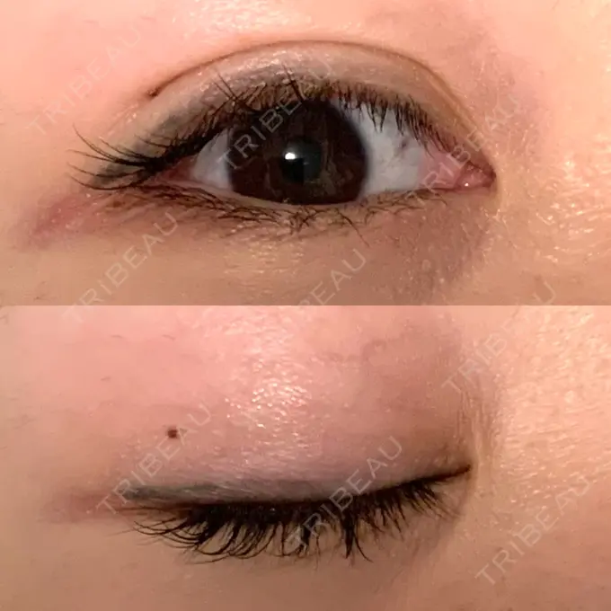 二重埋没 札幌ル・トロワ ビューティクリニックVogue AFTER メイン用