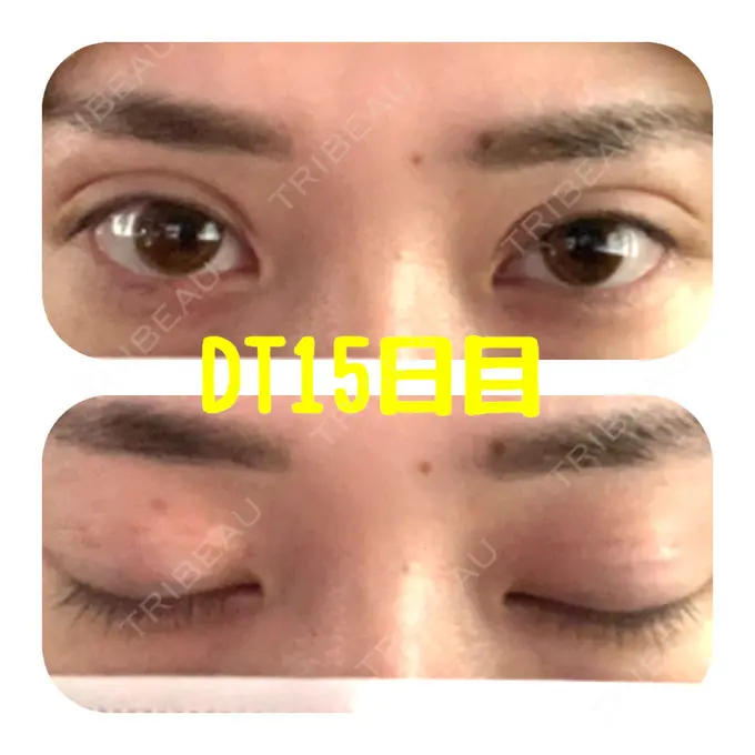 二重埋没 ハナビューティークリニック DAY 15 メイン用