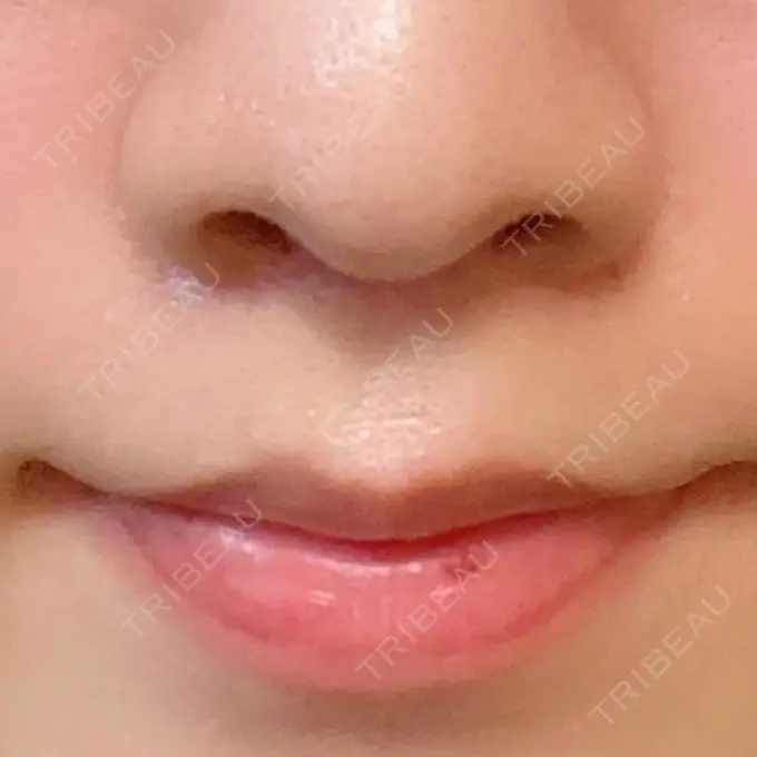 人中短縮 新宿ラクル美容外科クリニック 新宿院 AFTER メイン用