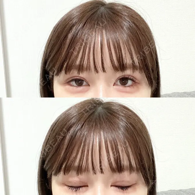 二重埋没 / その他（目元） CLASSY 仙台美容外科・美容皮膚科 DAY 10 メイン用