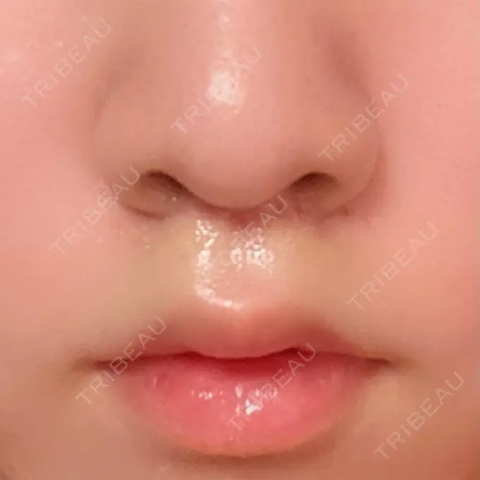 人中短縮 新宿ラクル美容外科クリニック 新宿院 DAY 36 メイン用