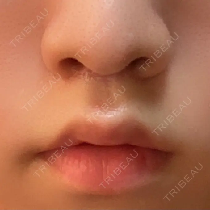 人中短縮 新宿ラクル美容外科クリニック 新宿院 DAY 40 メイン用