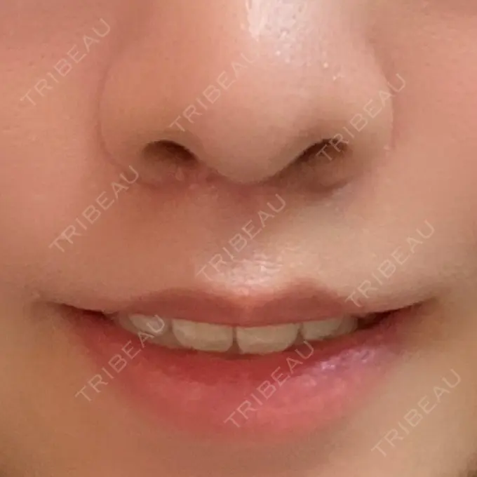 人中短縮 新宿ラクル美容外科クリニック 新宿院 DAY 40 メイン用