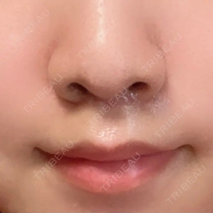 人中短縮 新宿ラクル美容外科クリニック 新宿院 DAY 41 メイン用