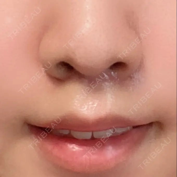 人中短縮 新宿ラクル美容外科クリニック 新宿院 DAY 41 メイン用