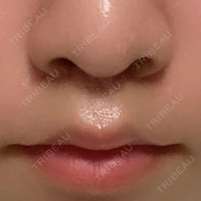 人中短縮 新宿ラクル美容外科クリニック 新宿院 DAY 90 メイン用