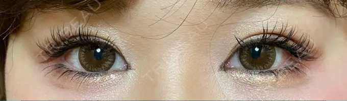 二重埋没 / ヒアルロン酸注入（涙袋） / ヒアルロン酸注入（目の下） 湘南美容クリニック 千葉センシティ院 DAY 94 メイン用