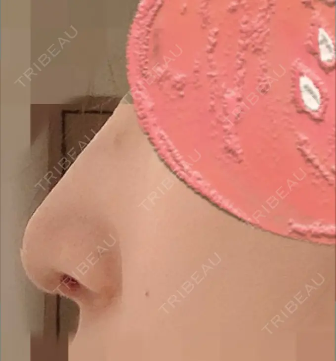 鼻尖形成（切開） / 軟骨移植 / ワシ鼻修正・ハンプ切除 麹町皮ふ科・形成外科クリニック DAY 10 メイン用